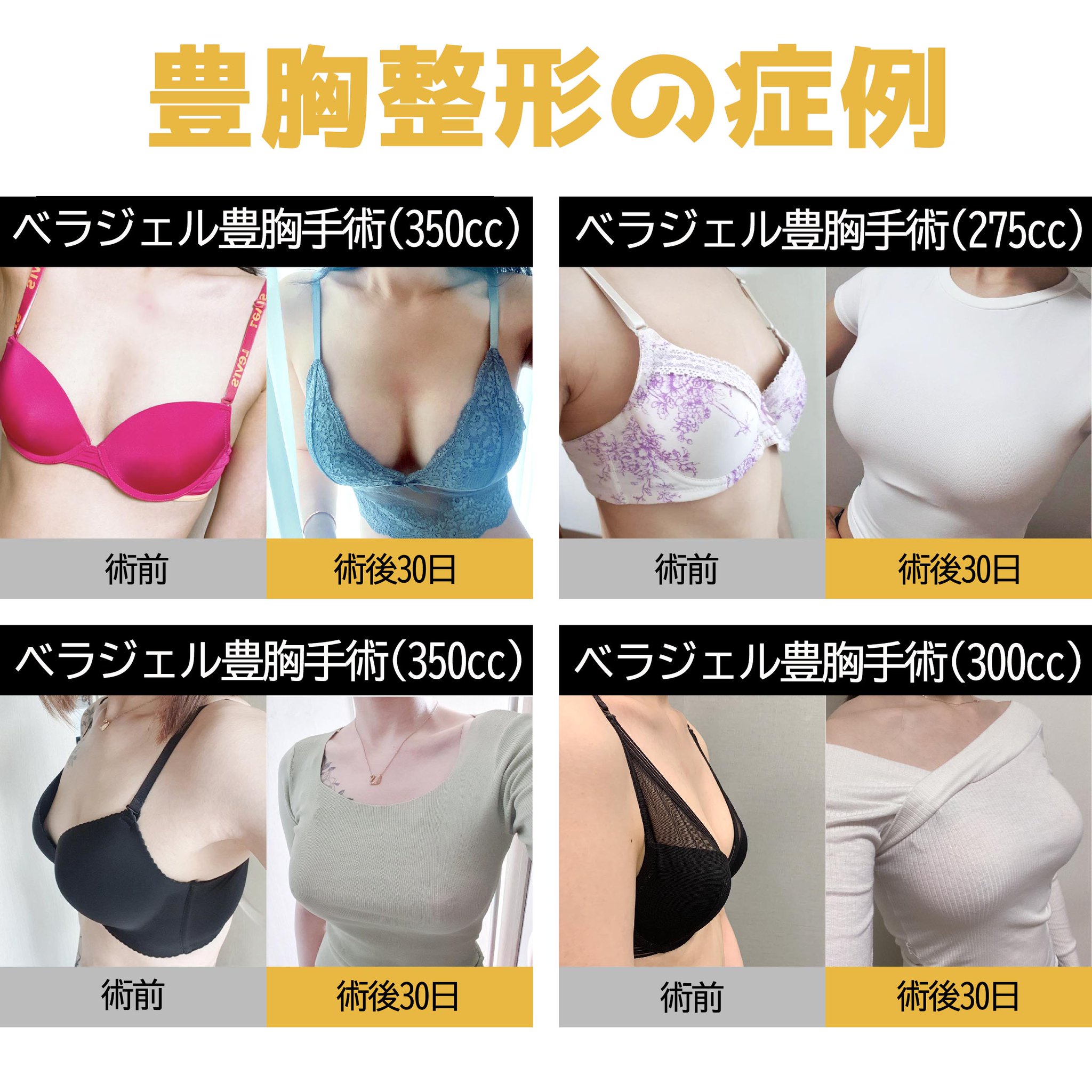 EVERA　韓国　美容　豊胸　美容整形　エベラ EVERA 韓国 美容 豊胸 美容整形 エベラ