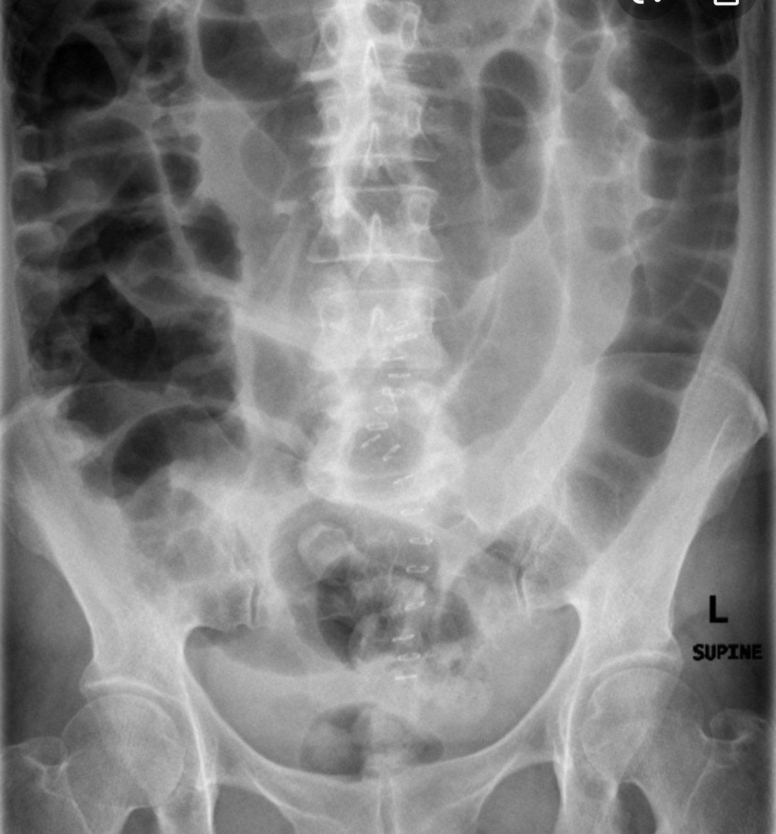 #quickcase #colorectalsurgery you are in the OR for a high grade bowel obstruction.  After resection and adhesiolysis, you have significant loss of domain.  What now?  Tips for getting belly closed?
