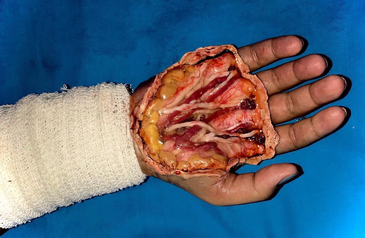 Mhmod511alhmdo's tweet photo. وجربنا تشريح اليد لأول مره☺️🖤، رايكمم؟
.
ميكب سينمائي|sfx makeup🎭
.
.
. . #ميكب #ميكب_ارتست #ميكب_أرتست #sfxmakeuptutorial #makeup #makeuplooks #makeupartist #sfxmakeup #fxmakeup #fx #sfxartist #اكسبلور #اكسبلور_explore #اكسبلور_فولو https://t.co/dSJF2h2zIp
