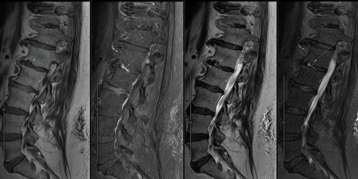 gmoonis's tweet image. Enhancing Schmorl&apos;s node without end plate edema  L1-L2( incidental schwannoma at same level). Would the spine folks call it acute schmorl&apos;s node? Invoke infection?  #neurorad #spinerad #radres
