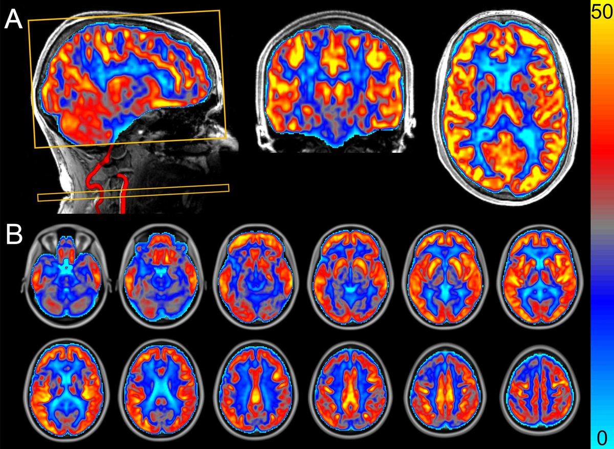 Interleucina6's tweet photo. El ejercicio no solo beneficia al bíceps, el ejercicio aeróbico mejora el rendimiento cognitivo, el lactato influye en la mielinización axonal, etc.
El sedentarismo es un intruso en la biología; Evolución. Movernos un poco más, nos aleja de E.Neurológicas
https://t.co/7KqTzb5FYu https://t.co/ojc3fwD98R