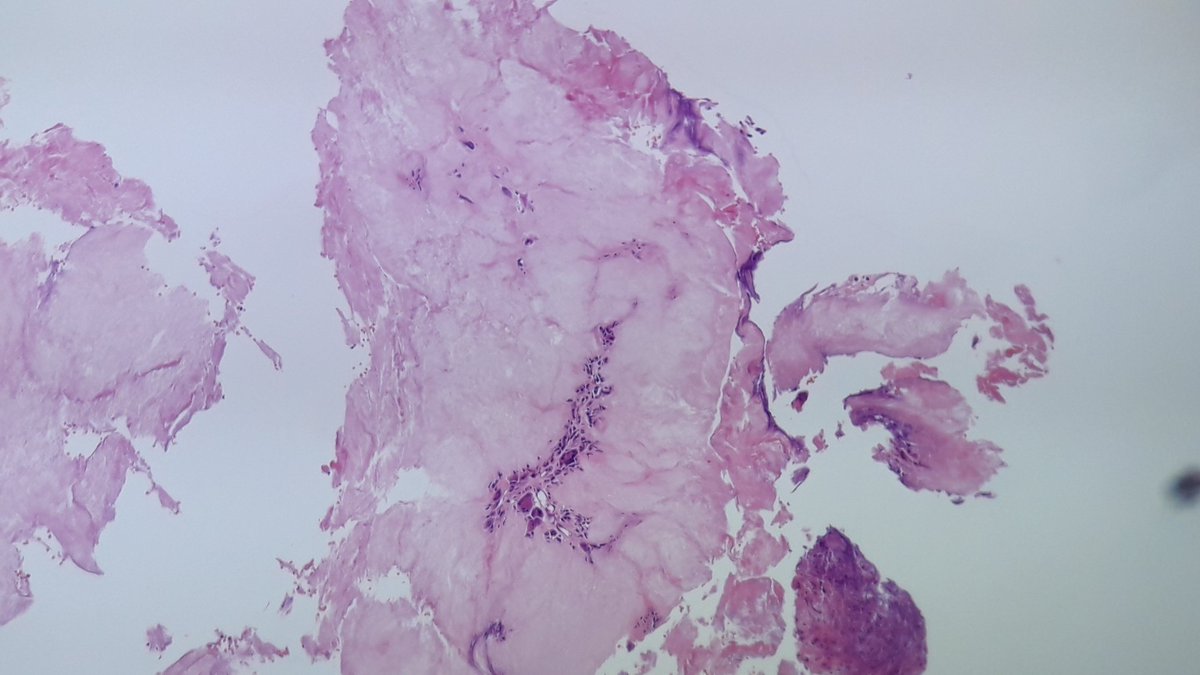 Spot diagnosis. Painful lesion of the toe.
#pathology #bstpath