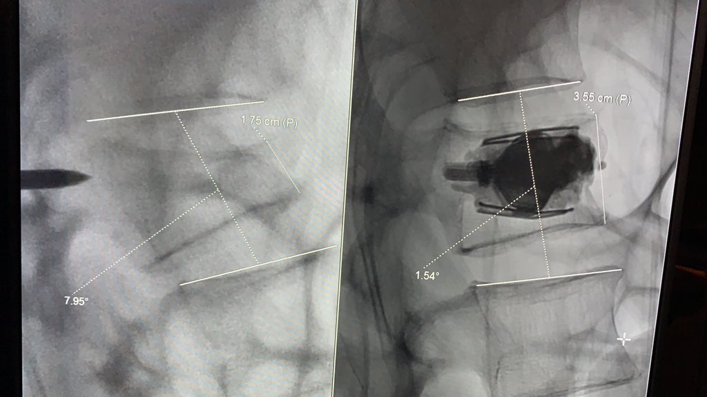 Fun with SpineJack!
Anterior vertebral height doubles! Focal kyphosis gone... <a href="/SIRspecialists/">Society of Interventional Radiology</a> <a href="/mjvillano/">Stryke V</a>