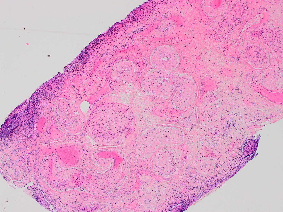 s_prendeville's tweet photo. Nice example of bladder amyloidosis #gupath 

🩺Can be localized or systemic

🔬 Usually see amyloid in lamina propria +/- muscle; may be mass-forming

🔬 Amyloid deposition in vessel walls (as in this case) is more often associated with systemic forms #pathpearl https://t.co/jqbkkTdIRg