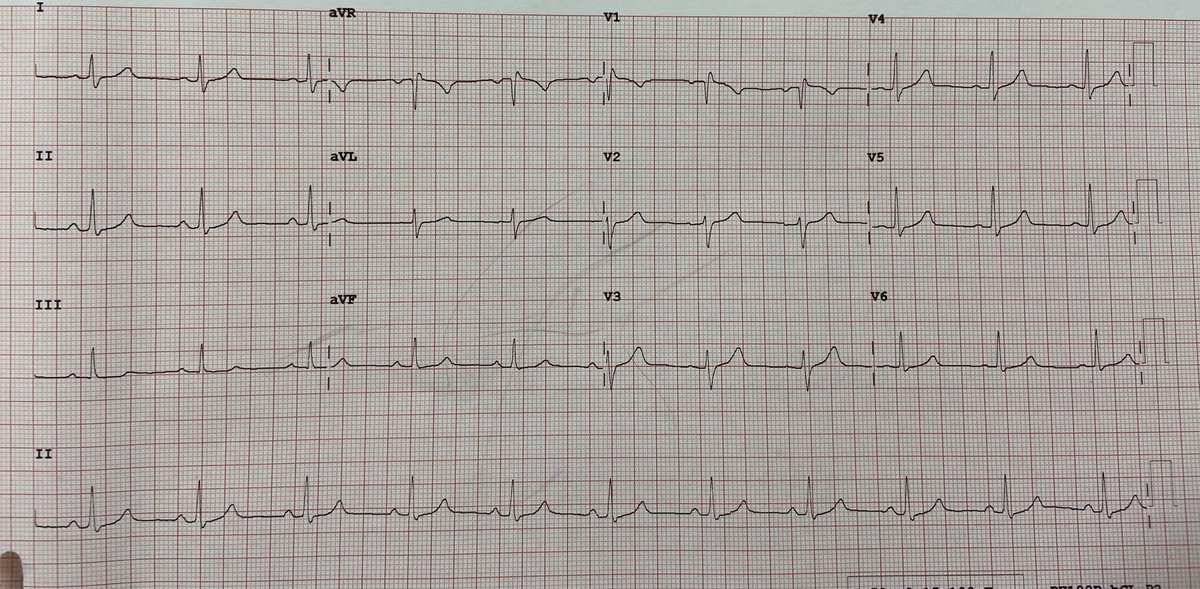 When you think something would be easily inducible, and it really wasn’t 😩 burst pacing, PES, isoprenaline, awake-ish pt .. any tips and tricks would be greatly appreciated #arrhythmia #EPeeps #cardiology #ECG #ecgchallenge #cardioed #MedTwitter #mededucation