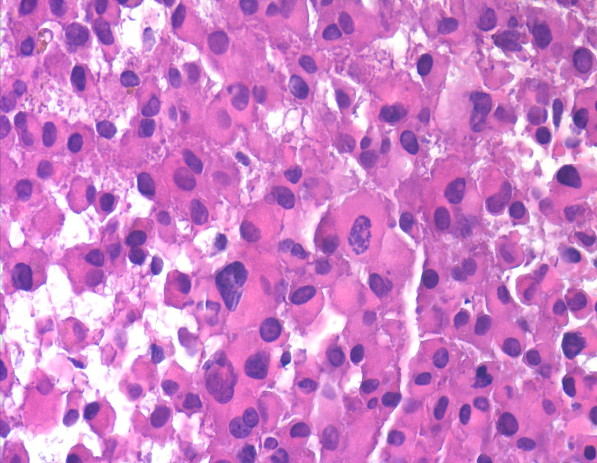 Soft tissue mass. NOT a met melanoma, Carcinoma or Mesothelioma. Most of you may only see 1-2 cases of this rare sarcoma in a lifetime of FNA practice. "Proximal-type Epithelioid Sarcoma - Epithelioid to rhabdoid cells, binucleation, macronucloli  and eosinophilic cytoplasm (CB).