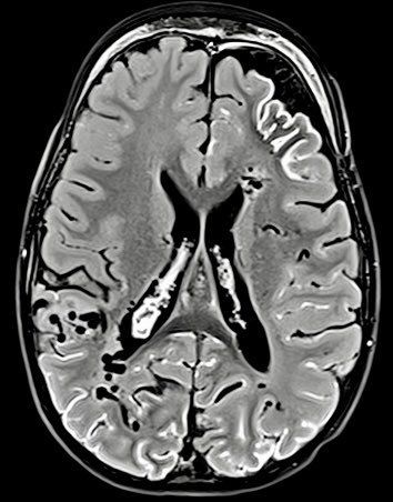 EpilepsiaRuber's tweet photo. El Síndrome de Sturge-Weber o angiomatosis leptomeníngea es una enfermedad genética que causa malformaciones vasculares craneales y epilepsia. Esta una RM (FLAIR postcontraste) de un paciente con el típico realce pial bilateral y una malformación arteriovenosa asociada.
#Epiteca https://t.co/uE5ztwpPdQ