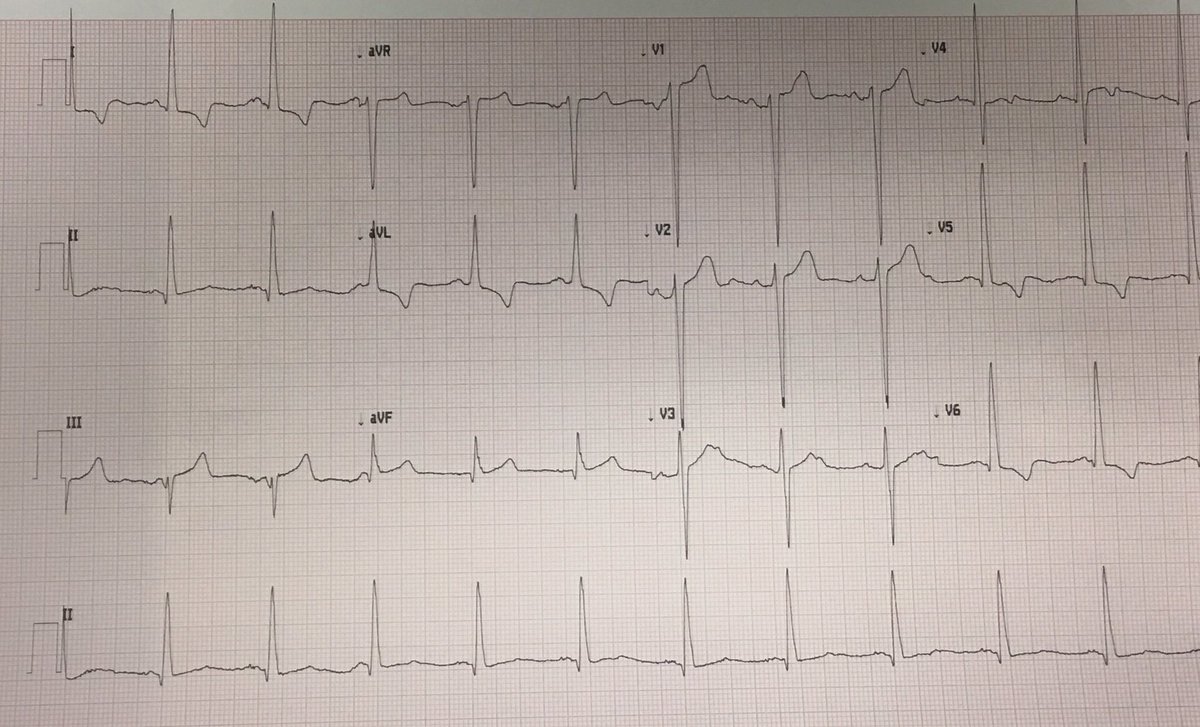 My diary tells me I’m supposed to be in Denver  @ASE360 but alas that’s not to be. Instead I have an echo to share with you. 1) ECG is the start of this story