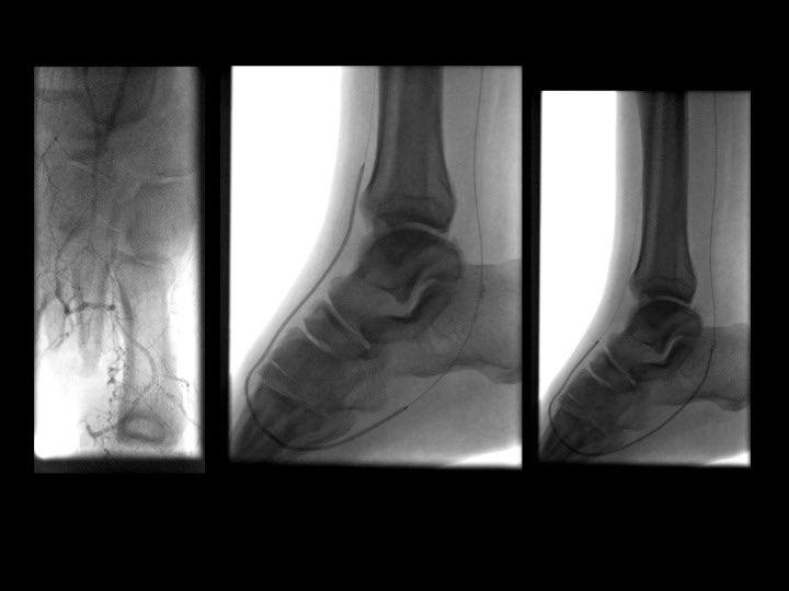 BSIR_News's tweet photo. Re-establishing pedal arch can be crucial treatment 4 diabetic foot ulcers.  All cases discussed in MDM @GSTTnhs by #irad.  Pedal loop technique below with @ADiamantop. #CLIFighters :@Irfan_I_Ahmed @leonardo_monzon @narayan_karu NT,PG,SI,TS,UR @GregMakris23 @AneetaParthipun Mj SM https://t.co/17vEiMNd40