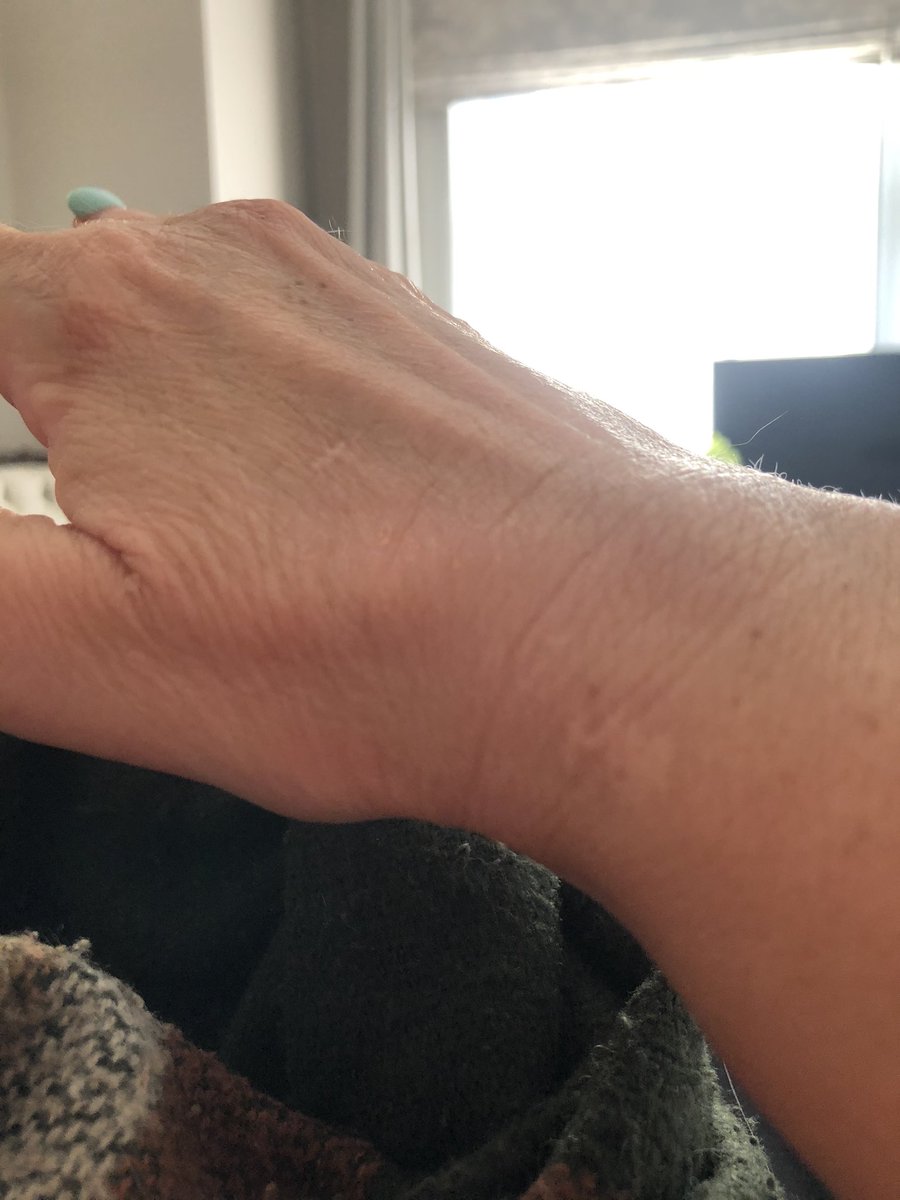 Here’s a hand update Twitter ... thanks for all concern . We have come through it well #BurnCollective- <a href="/LisaArmitage_/">Lisa Armitage Skincare</a> balm amazing <a href="/treatmentroom/">Clare Rogers</a> lavender oil took awful it h away ❤️