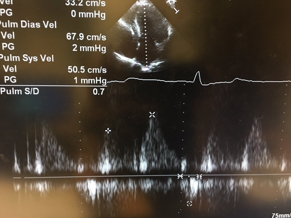 7) and lastly, perhaps unsurprisingly, there was pseudonormal filling with high filling pressures.  #hocm  #echofirst