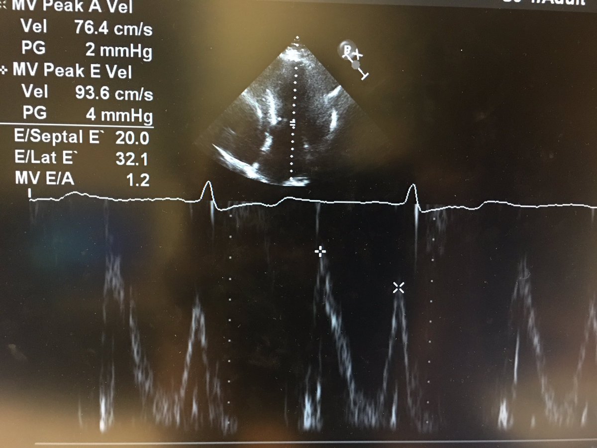 7) and lastly, perhaps unsurprisingly, there was pseudonormal filling with high filling pressures.  #hocm  #echofirst