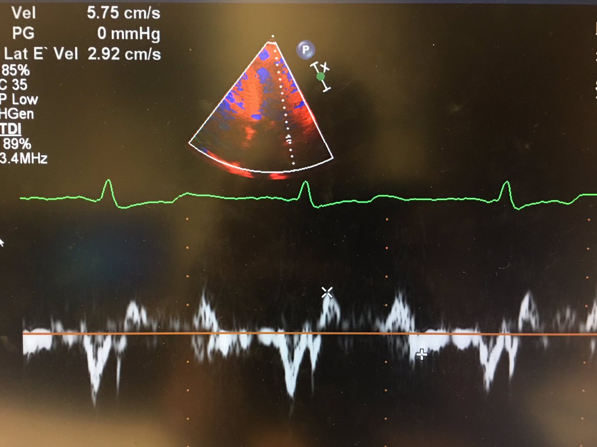 7) and lastly, perhaps unsurprisingly, there was pseudonormal filling with high filling pressures.  #hocm  #echofirst