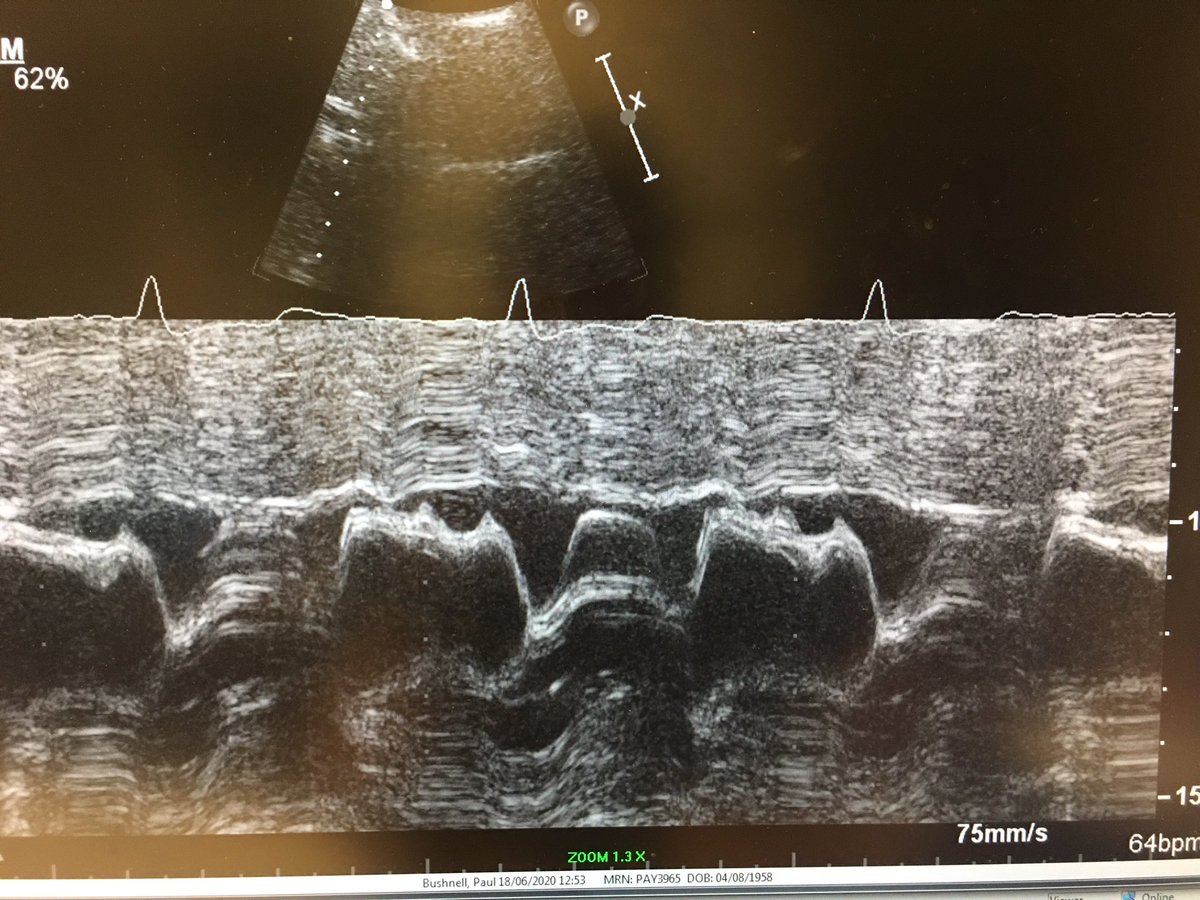 6) and because I’m old I did a couple of m-modes - one to show the systolic anterior motion (SAM) and the early closure of the aortic valve.  #HOCM