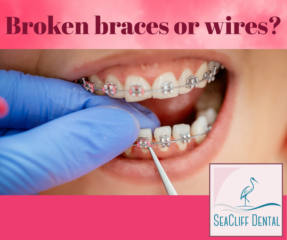 SeaCliffSF's tweet photo. Broken braces or wires? Poking your cheek, tongue, or gum? Use pencil eraser to reposition. Or cover wire end w/ orthodontic wax, small cotton ball, or gauze. Don't cut the wire! Call us right away. #brokenbraces #brokenwires #brokenbrackets #braces #wax #SeaCliffDentalSF https://t.co/lzKnq5iKA9