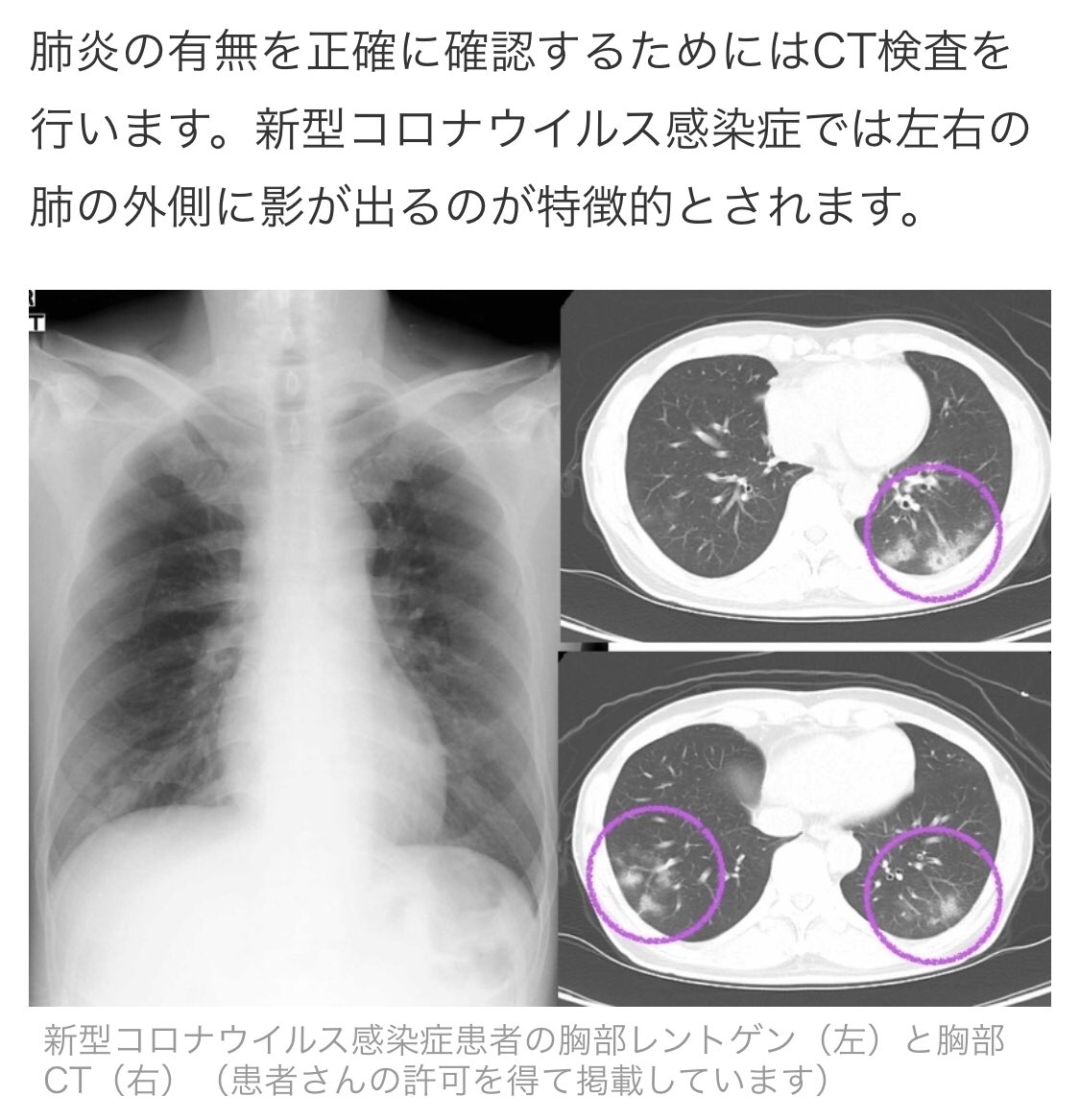 怒りのアビガン Covid19対策 Sur Twitter ダイヤモンドプリンセスの無症状陽性者の約半数に肺に白い影が見つかっている 普通の細菌性肺炎は片肺だけが多い 新型コロナは両肺に火花のような影 肺胞ではなく間質が酸素交換出来なくなる 原因はウイルスによる肺