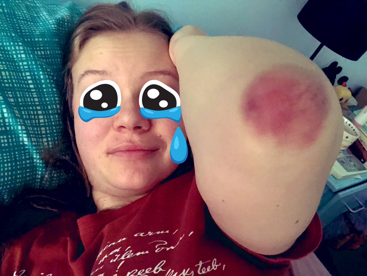 PillPopcast's tweet photo. When you’re chronically anaemic but decide you should try out martial arts anyway (TW for nasty bruising) #chronicillness #PillPop #listenOnAllPodcastApps 💊 🎧 https://t.co/8ZHVSjb8Cu