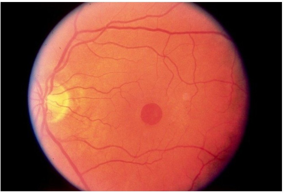 spot of eye (macula)  #solarretinopathyAs the retinal cells are not capable of regeneration, this loss of rods and cones is permanent.In severe cases, it may lead to the formation of macular hole.