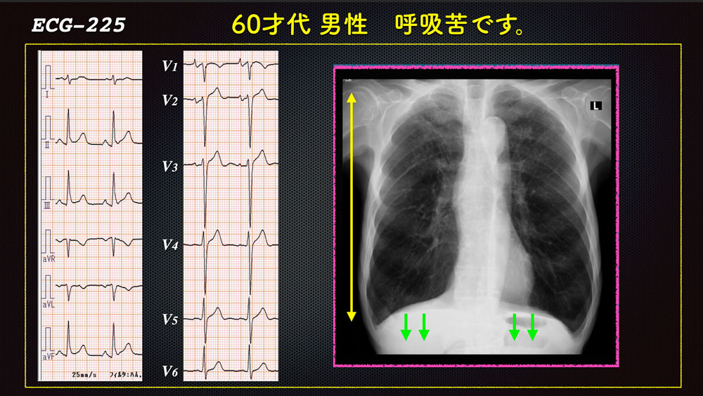 N Tsukishima 心電図検定試験対策 始めました Na Twitteru Lead I Sign 012 胸部の水平断を見ると分かりますが 肺動脈が前 大動脈が後方です 心臓は肺動脈弁 大動脈弁で吊されているので 反時計回転できません 横隔膜が低下すると 自然と心臓は時計方向回転し