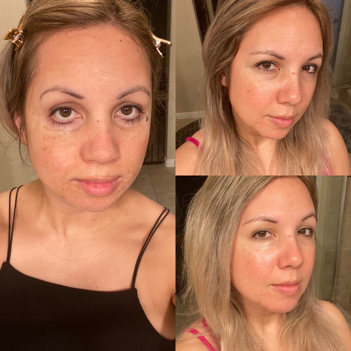 eurcynia's tweet photo. I don’t know if #Hanacure was effective in one treatment — the before (top right) versus after (bottom right) but the in between is HILARIOUS 😂😂😂 https://t.co/GOLdvSmwk6