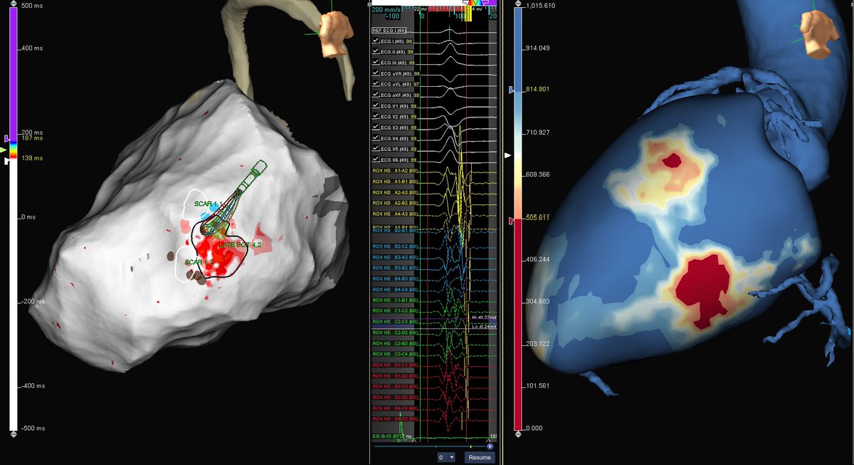 ivroca's tweet photo. Again HD mapping and MRI together in an epicardial ablation of LV displasia.....CT also helped to avoid coronary artery damage....#AblateVT #EPeeps @ADAS3D @hospitalclinic #hdgrid #gridenvy https://t.co/AXrkjIwaaQ