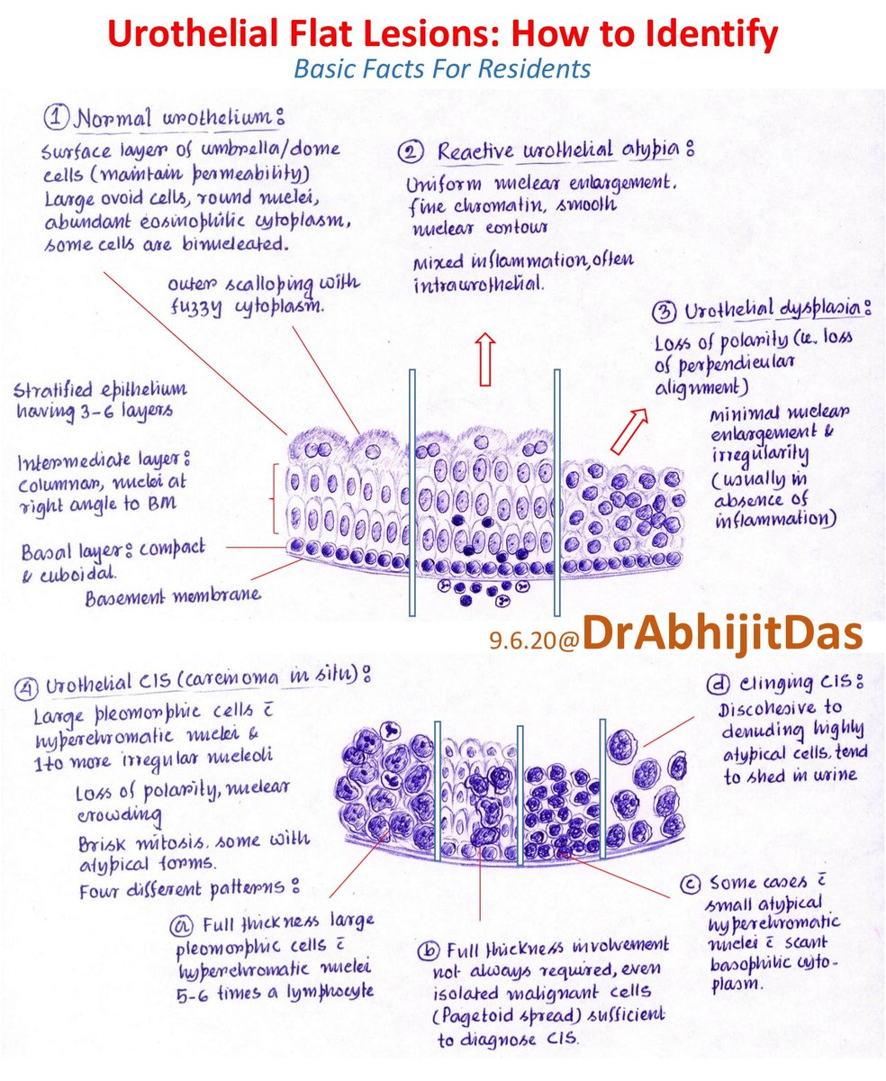 Uropathology: basic facts How to differentiate between urothelial flat lesions like reactive urothelial atypia, dysplasia & carcinoma in situ? Simplified schematic with salient features for residents #MakeSurgiPathEasy #Uropath #BasicFactsForResidents