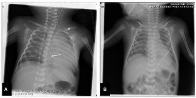ISaveThatLine's tweet image. Open Access Case Report and Literature Review: Pericardial Effusion/Cardiac Tamponade Induced by #PICCs in Low Birth Weight Infants #neonatal #pediatrics bit.ly/2UUwn6H