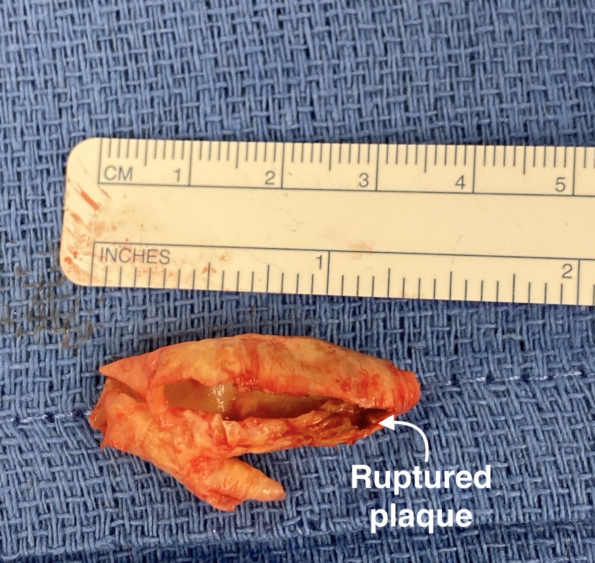 This patient presented with a symptomatic #carotid stenosis.  CTA showed a string sign of the ICA. The patient underwent #carotidendarterectomy which revealed a ruptured plaque of the ICA. The artery was patched and the patient did well postoperatively.