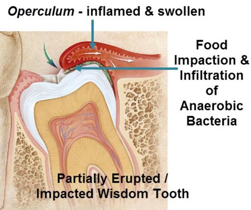 1.Gigi bongsu tumbuh-saya demam dan sakit doc!Sebenarnya gigi bongsu tumbuh tak sakit pon.yang sakit adalah apabila ADA MAKANAN/BACTERIA melekat di celah2 gusi semasa gigi tersebut keluar. Bila bacteria bermaharajalela dibawah gusi,infeksi mula berlaku dipanggil pericoronitis.
