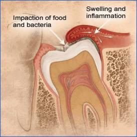 Tapi banyak juga org yg “eh gigi bongsu saya semua dah tumbuh? Saya tak perasan pon?” Biasanya golongan ini adalah yang mempunyai oral hygiene yg tiptop,bersihkan gigi smpai hujung rahang di kedudukan gigi geraham bongsu tadi.