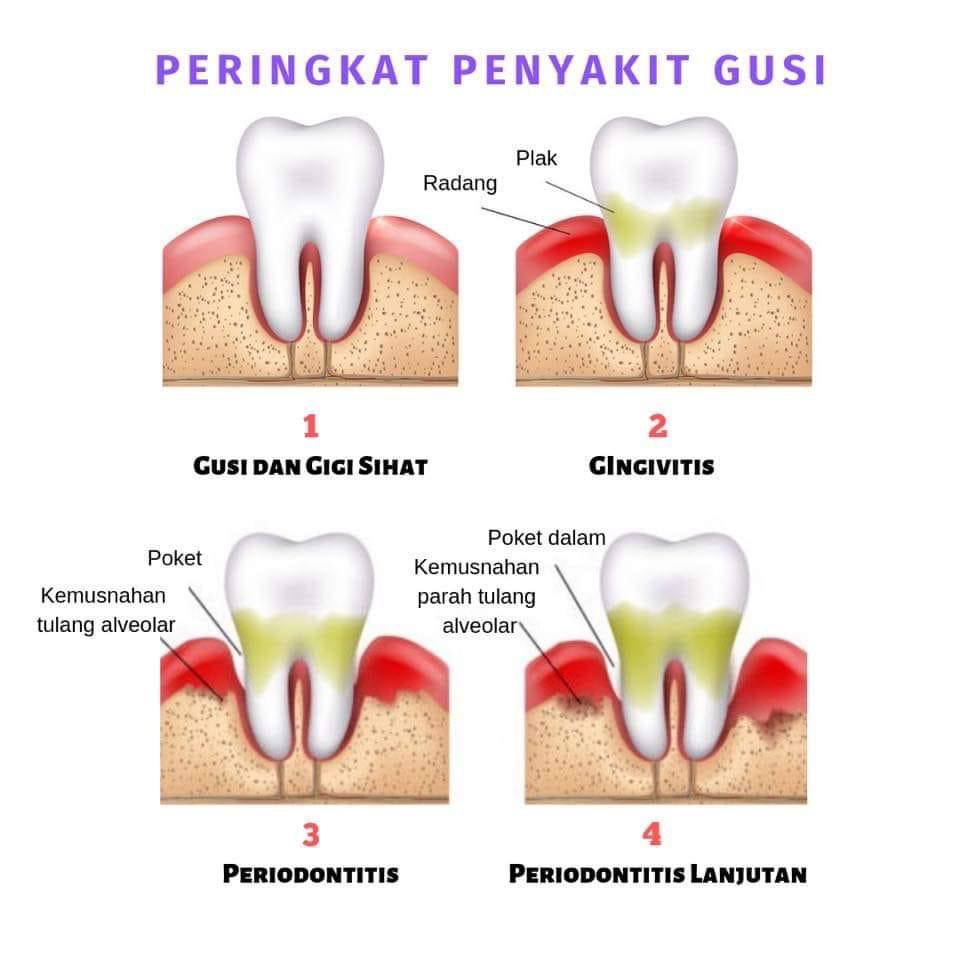 Gingivitis ni boleh menjadi lebih teruk apabila ia tak dirawat dan menular untuk menjangkiti tulang rahang yang memegang gigi.Inilah yang menyebabkan gigi menjadi goyang.