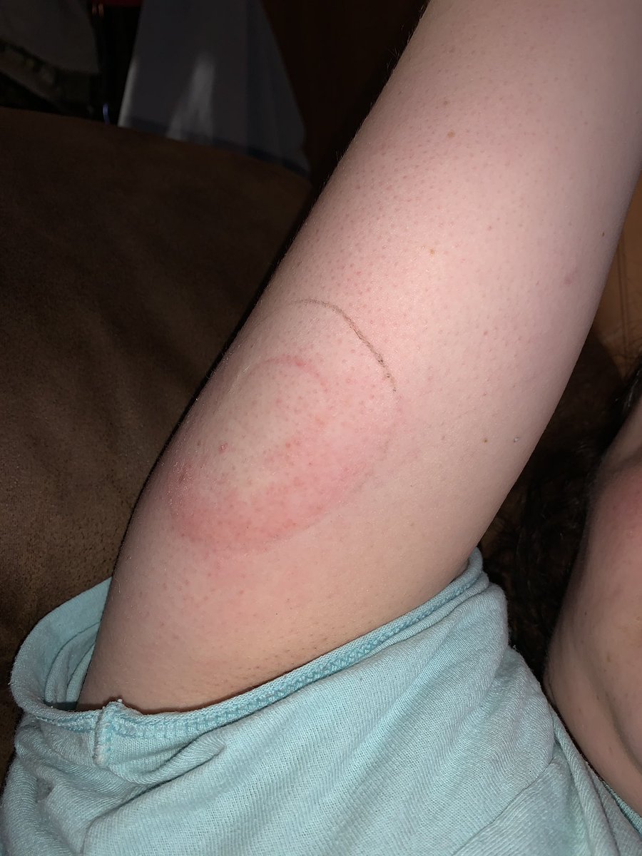 briauna_renee18's tweet photo. took my sensor off cause yallllllll πππ« i couldnβt stand the ITCH!!!!! but look how every sensor spot looks after it comes off.. #type1diabetes #type1probs #diabetes #diabetic #cgm you can literally see the welts in the 2nd pic.. π«π«π« https://t.co/InKojKaFOu