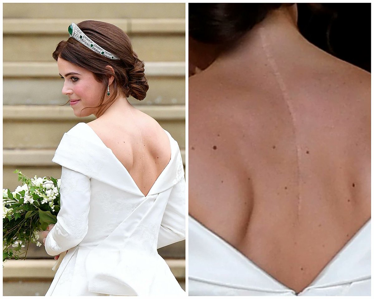 Eugenie's beautiful backless Peter Pilotto wedding dress was deliberately designed to show the scar from her op.