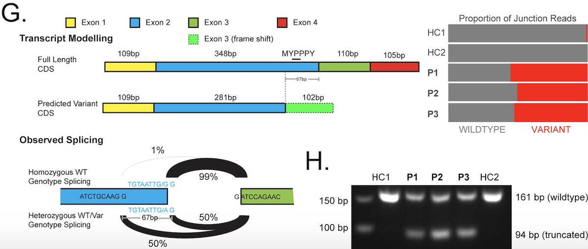 Phan Lab (@labphan) on Twitter photo Another great patient outcome <a href="/CIRCA_genomics/">The Clinical Immunogenomics Research Consortium</a>, <a href="/kinghorngenomes/">Kinghorn Genomics</a> and <a href="/GarvanInstitute/">Garvan Institute of Medical Research</a>. CTLA4 haploinsufficiency 2Ë to cryptic splicing presenting with Kaposi sarcoma treated with everolimus. Thx to <a href="/aifa_news/">AIFA</a> <a href="/StVincentClinic/">St Vincent's Clinic</a> <a href="/Info4PI/">Jeffrey Modell Foundation (JMF)</a> and the patients!
link.springer.com/article/10.100⊠Another great patient outcome <a href="/CIRCA_genomics/">The Clinical Immunogenomics Research Consortium</a>, <a href="/kinghorngenomes/">Kinghorn Genomics</a> and <a href="/GarvanInstitute/">Garvan Institute of Medical Research</a>. CTLA4 haploinsufficiency 2Ë to cryptic splicing presenting with Kaposi sarcoma treated with everolimus. Thx to <a href="/aifa_news/">AIFA</a> <a href="/StVincentClinic/">St Vincent's Clinic</a> <a href="/Info4PI/">Jeffrey Modell Foundation (JMF)</a> and the patients!
link.springer.com/article/10.100âŠ