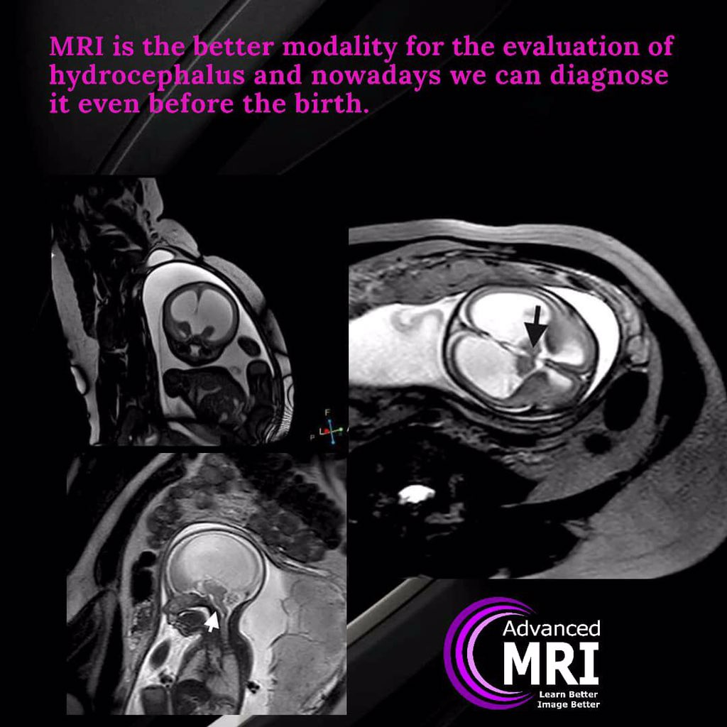 advanced_mri's tweet photo. Hydrocephalus🧠
#mri #pathology #advancedmri #advanced_mri #advancedmripathology #radiologist #medicine #technologist #hydrocephalus https://t.co/Ly75Oi829G