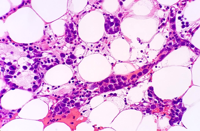 javidiparsijani's tweet photo. Intravascular Large B cell Lymphoma: large CD20(+) CD5(weak +) lymphoma cells are confined to CD34(+) sinusoids in the marrow #rarelymphoma https://t.co/Dpwr7ug1FY