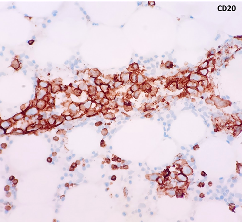 javidiparsijani's tweet photo. Intravascular Large B cell Lymphoma: large CD20(+) CD5(weak +) lymphoma cells are confined to CD34(+) sinusoids in the marrow #rarelymphoma https://t.co/Dpwr7ug1FY