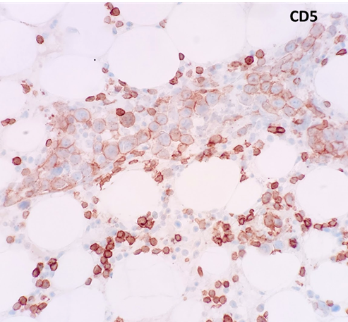 javidiparsijani's tweet photo. Intravascular Large B cell Lymphoma: large CD20(+) CD5(weak +) lymphoma cells are confined to CD34(+) sinusoids in the marrow #rarelymphoma https://t.co/Dpwr7ug1FY