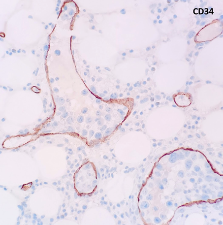 javidiparsijani's tweet photo. Intravascular Large B cell Lymphoma: large CD20(+) CD5(weak +) lymphoma cells are confined to CD34(+) sinusoids in the marrow #rarelymphoma https://t.co/Dpwr7ug1FY