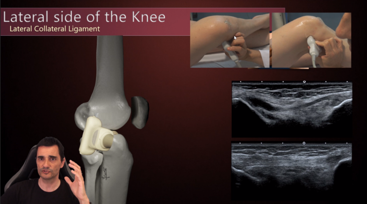 Soon I will release my next video:

Knee  Anatomy &amp; US (Part 3/4): Lateral side

If you want to be informed about new videos, suscribe to my YouTube channel following this link:

youtube.com/channel/UCu-Aa…