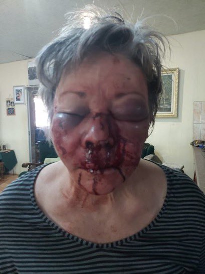 KTHopkins's tweet photo. DISTRESSING 
Elderly white couple brutally attacked by black gang. 

White gentleman burned with kettle of boiling water, then strung up in shower. This is his wife after the attack. 

Because they are white the world looks the other way #BlockKatieHopkins #BLM #plaasmoorde https://t.co/YAZPb8CE4n