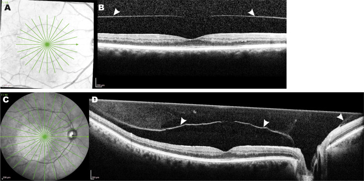 AAOjournal's tweet photo. In study of 157 eyes, 6 mm spectral domain optical coherence tomography is able to distinguish complete and partial posterior vitreous detachment. Posterior vitreous detachment begins in the mid-periphery, and may occur as early as the teenage years https://t.co/8wJLxS6C3B https://t.co/etXhTjYTg6