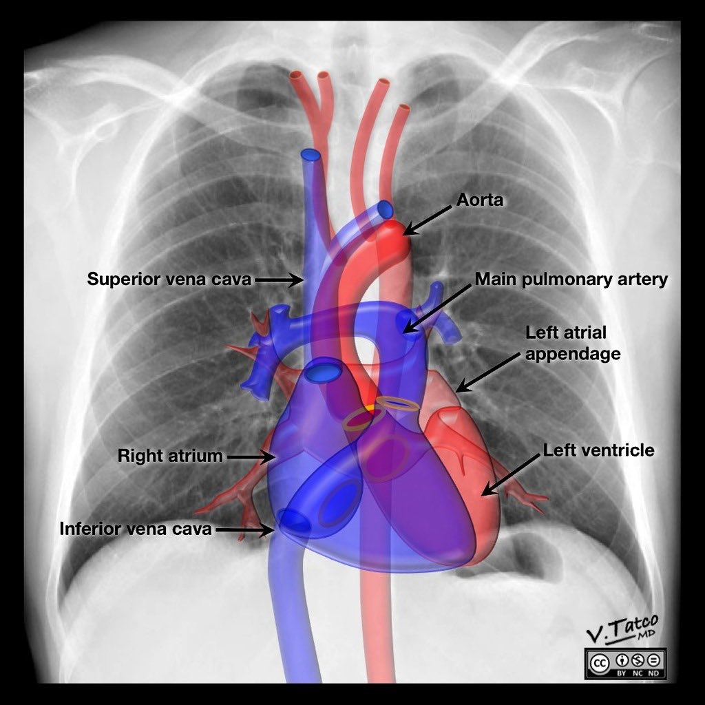 DrAndrewDixon's tweet image. The latest @Radiopaedia free featured video is Mediastinal Anatomy by @drcraighacking. Includes two scrollable CT quizzes and amazing illustrations by @DrVinceTatco 👏

WATCH: radiopaedia.org/courses/featur…