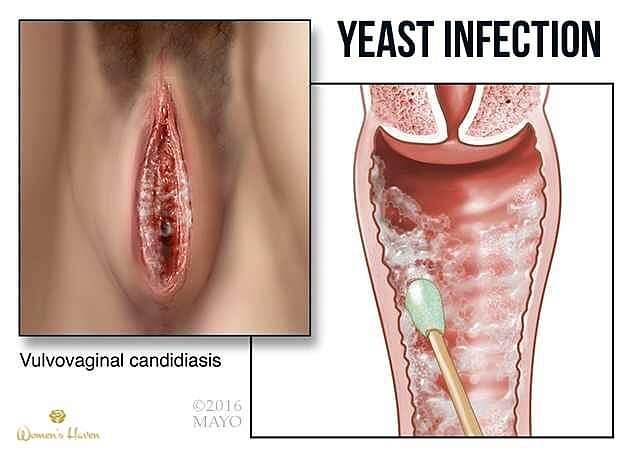 Vaginal yeast infection