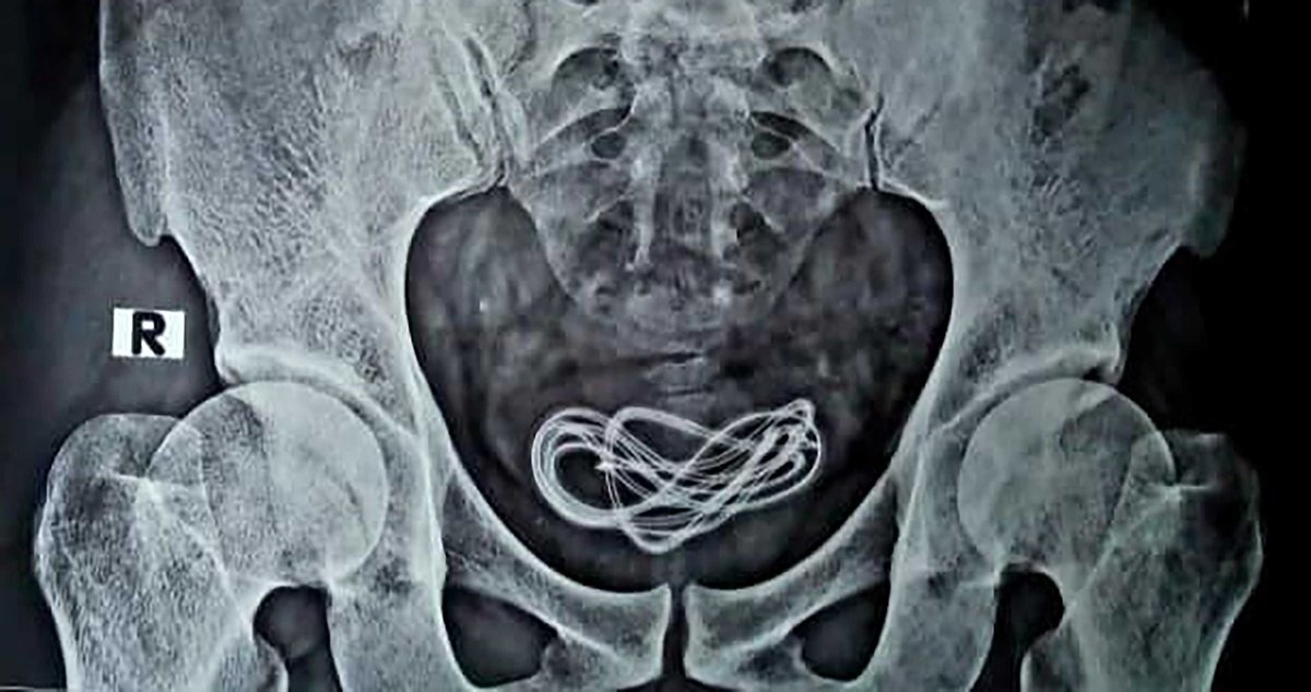 MobileSyrup's tweet photo. Man has phone charger removed from bladder after inserting it into penis https://t.co/ch7ZvXff6O https://t.co/WOzhG8Gn9U