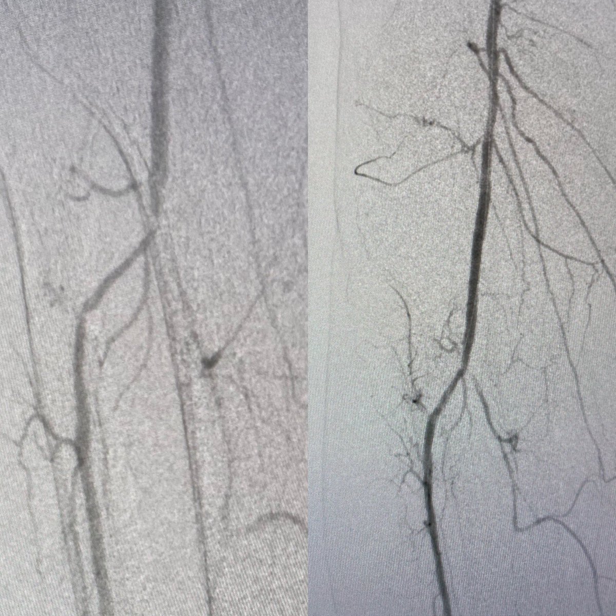 Impressed with the <a href="/BDandCo/">BD</a> Rotarex device for combo atherectomy/thrombectomy.

Pt with acute on chronic occlusion of his SFA. Good lumenal gain with device, followed by DCB. Didn’t use filter and relied on the thrombectomy function for distal protection.