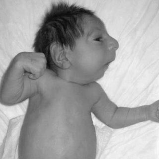 ibr78ibr's tweet photo. متلازمة سيكل seckle syndrome
هو اضطراب جيني وراثي بسبب نقص الجينات الموجوده على كروموسومات 3 و 18 تؤدي لتشوهات خلقية وخلل في النمو وإعاقة عقلية العلامات البارزة صغر الرأس والانف المنقار وبروز الأذنين وتشوهات الاسنان https://t.co/olN7uHmpz8
