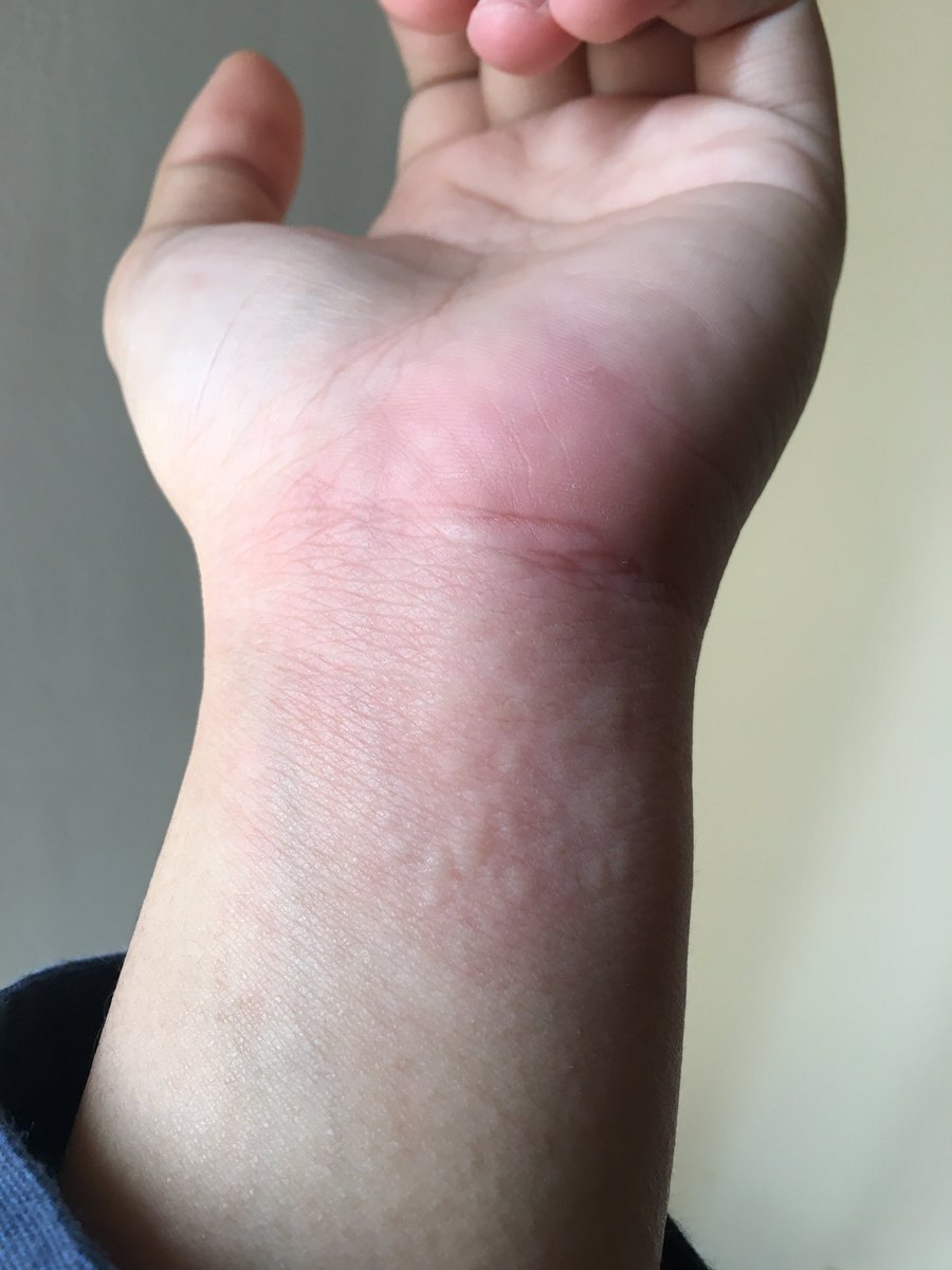 baru kali ini alergi makan kerang luar biasa