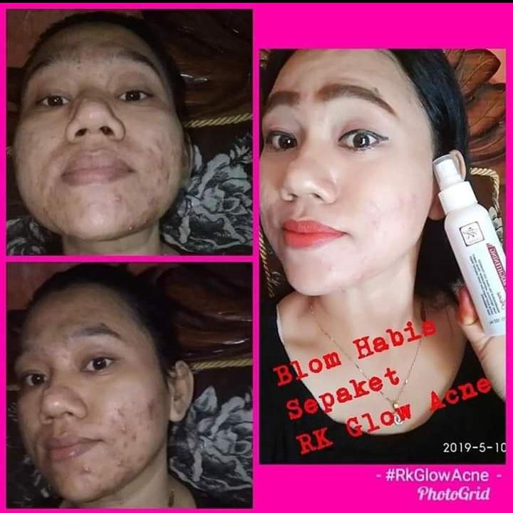AyuViral's tweet photo. Yg mw menuntaskan jerawatnya pakai 
RK Glow donk
Yg mw glowing 
Pakai RK Glow
Yg mw putih tanpa pengelupasan
Pakai RK Glow 
Minat 
https://t.co/LPhKScz2Ab https://t.co/Mv7pxp64xp