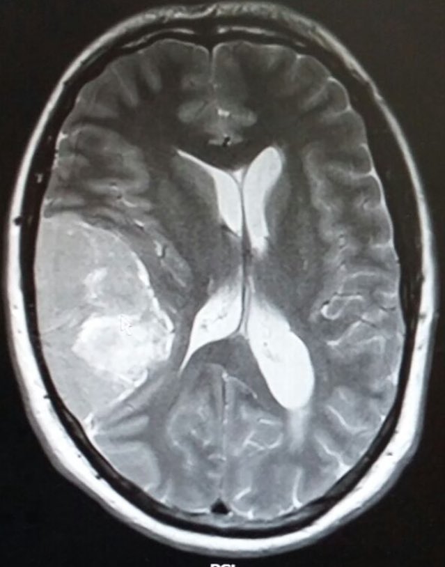 Yesterday was #WorldBrainTumourDay I feel lucky everyday, got my Feb scan results recently: No regrowth. Hard to believe this #meningioma was in my head, massive thank you to @SheffieldHosp #nhs